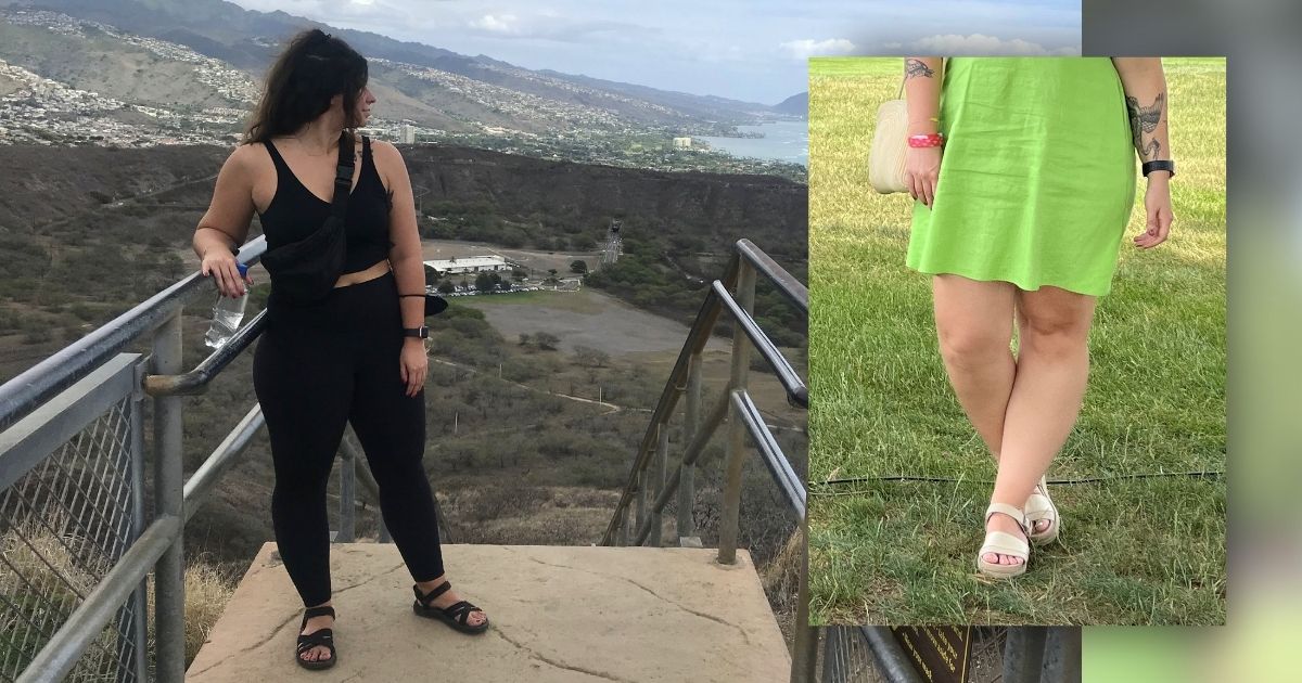 11% of Women Have Lipedema—Are You One of Them?